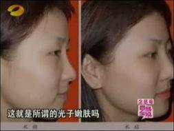 光子嫩肤视频大全,揭秘美容护肤新趋势